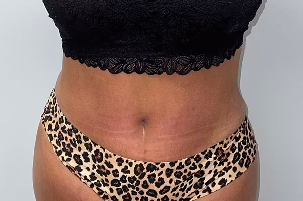 After: abdomen and waistline before and after with Dr. Balinger