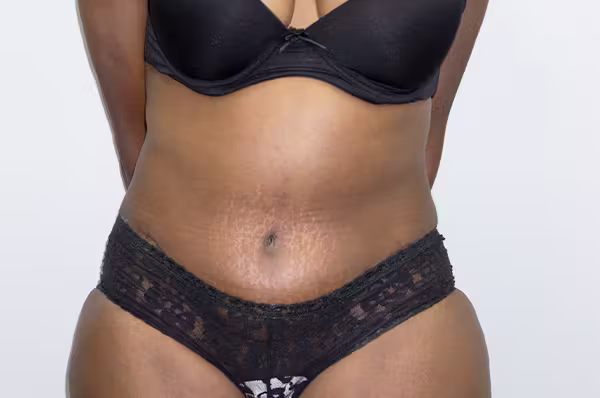 After: abdomen contouring before and after with Dr. Balinger