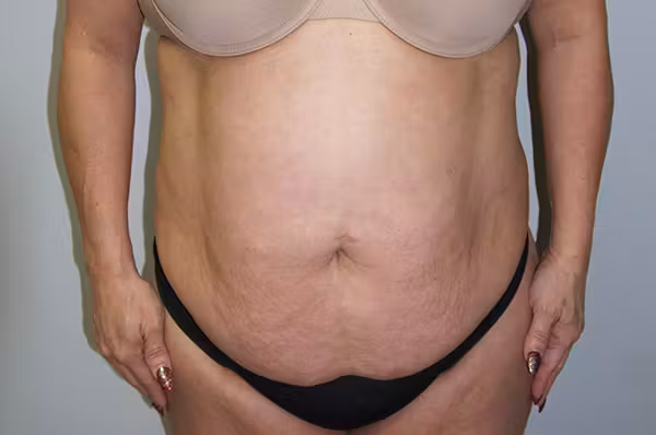 Before: abdomen and waistline before and after with Dr. Balinger