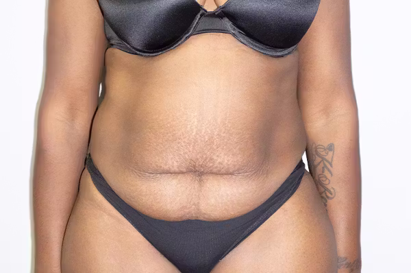 Before: abdomen contouring before and after with Dr. Balinger