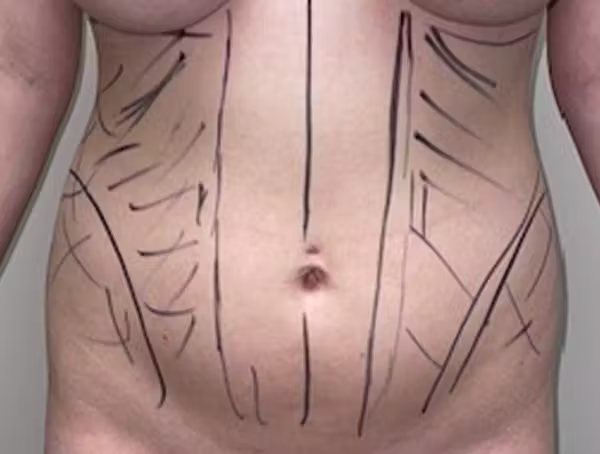 Before: abdomen and waistline before and after with Dr. Balinger