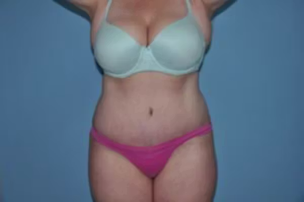 After: abdomen before and after a tummy tuck with Dr. Balinger