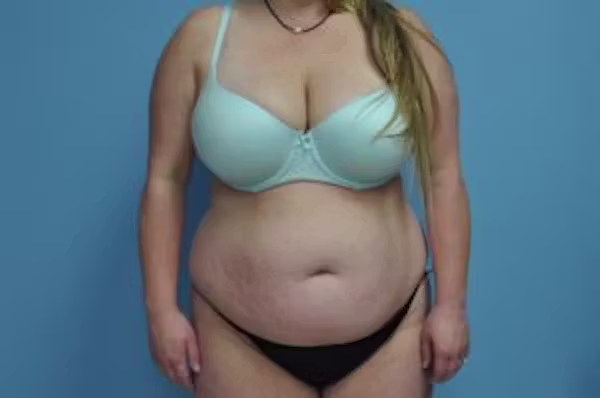 Before: abdomen before and after a tummy tuck with Dr. Balinger